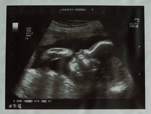 ultrasound image of a baby